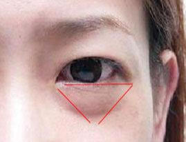 激光除眼袋效果如何？激光去眼袋要注意什么？