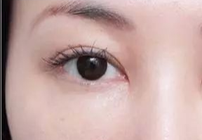 激光去眼袋什么人適合？