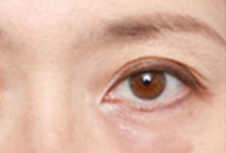 激光去眼袋幾天能恢復(fù)？激光去眼袋是怎樣的？