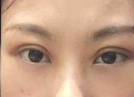 激光去眼袋可保持多久？激光去除眼袋效果好不好？