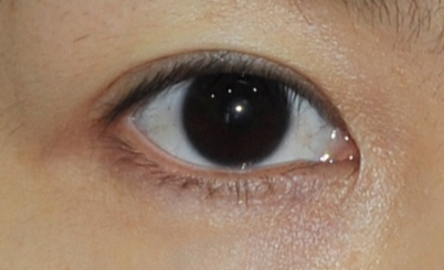 激光去眼袋前后明顯嗎？激光去眼袋安全嗎？