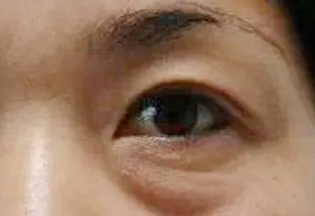 激光去眼袋會反彈嗎？