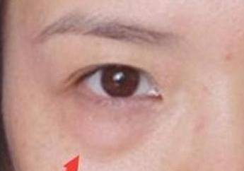 激光去眼袋的效果怎么樣？激光去眼袋注意事項(xiàng)有哪些？