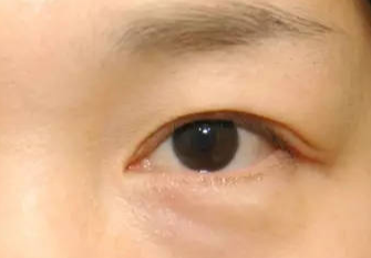 激光去眼袋術后會不會反彈？激光去眼袋術后注意事項？