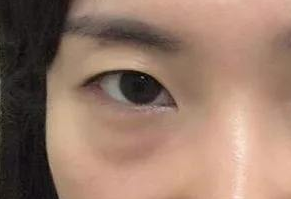 激光去眼袋有什么危害？激光去眼袋幾天能消腫？