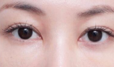 激光去眼袋安全嗎？