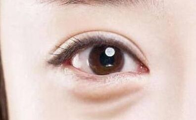 激光去眼袋是永久的嗎？激光去眼袋多少錢？