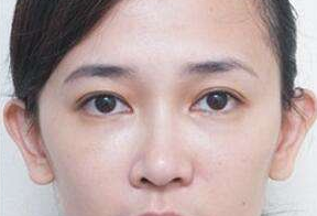 激光去眼袋后要休息多久呢？激光去眼袋會很痛嗎？