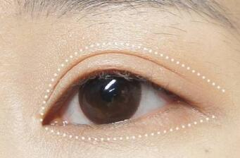 煙臺雙眼皮修復(fù)整形醫(yī)院哪幾家技術(shù)好？這10家醫(yī)院不容錯過！