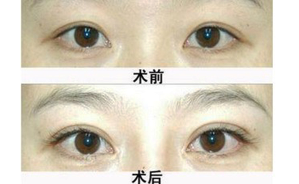 睫毛少是什么原因?睫毛少又短怎么辦?