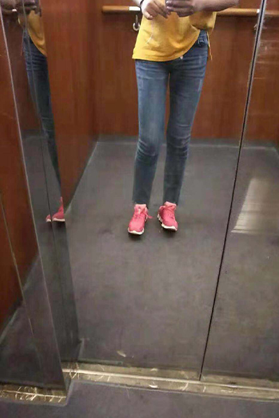 大腿環(huán)吸術術后成型效果