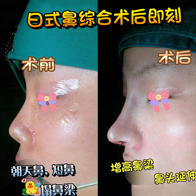 日式鼻綜合術(shù)前術(shù)后效果圖