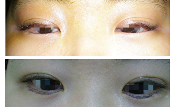 眼瞼內(nèi)翻什么意思？眼瞼內(nèi)翻怎么辦？