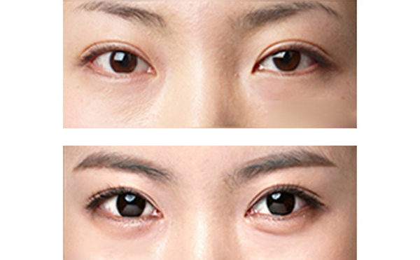 “眼瞼嫵媚術”是什么?怎么做?