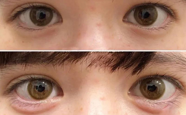 玻尿酸豐臥蠶效果是永久的嗎?術(shù)后有什么風(fēng)險(xiǎn)?