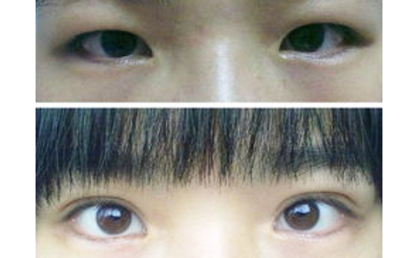 埋線(xiàn)雙眼皮能去腫眼泡嗎?可以維持多久?