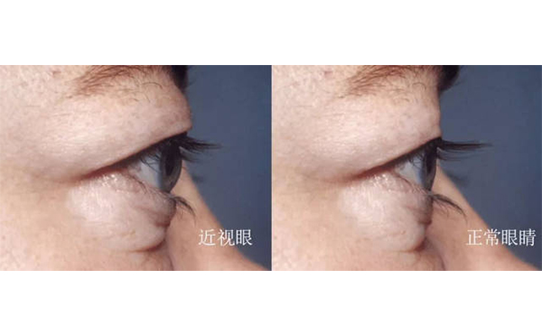 眼球突出矯正術(shù)安全嗎?術(shù)后會(huì)不會(huì)復(fù)發(fā)?