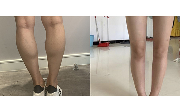 瘦腿針和吸脂哪個好？