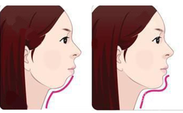 注射墊下巴的方式好嗎？