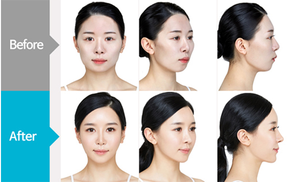 改臉型手術(shù)參考價(jià)格是多少?