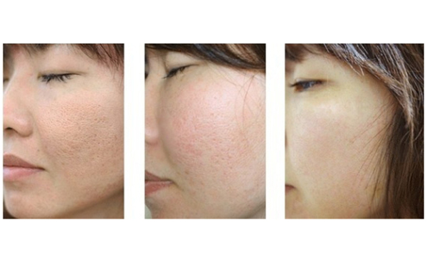 毛孔粗大需要做幾次彩光嫩膚？