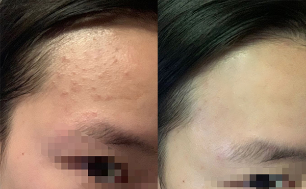 果酸煥膚后皮膚會(huì)變薄嗎？