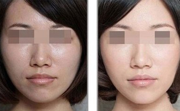 美白針的效果怎么樣？