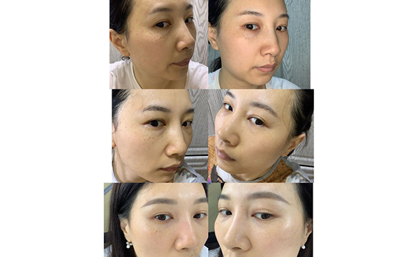 激光祛斑安全嗎？