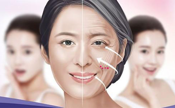 什么是埋線提升？