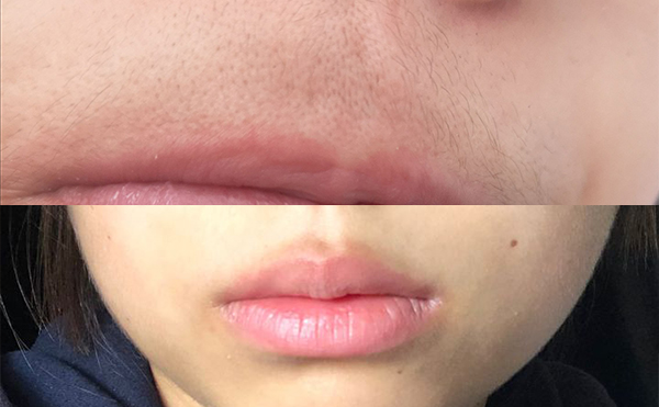 激光面部脫毛能脫得干凈嗎？