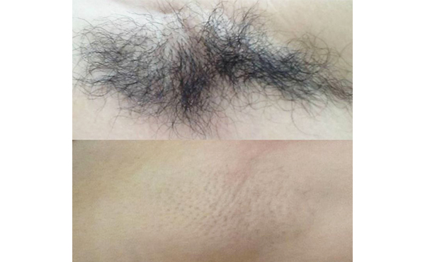 激光脫腋毛疼嗎？