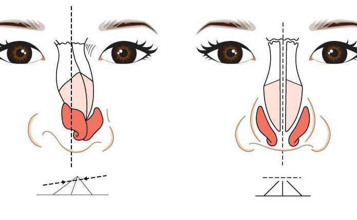 鼻子歪矯正大約多少錢？鼻子歪矯正恢復(fù)期多久？