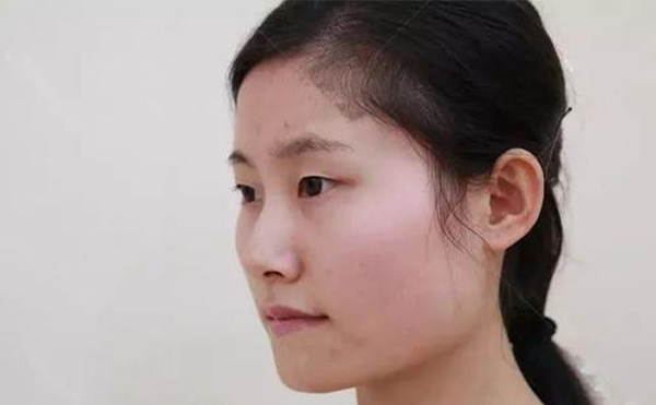 下頜角切除后還會再長嗎？