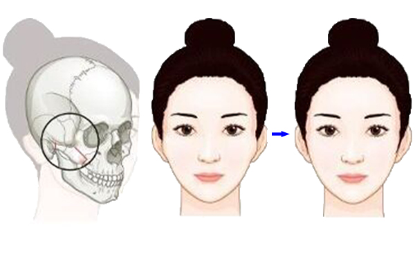 顴骨降低整形手術是怎么操作的？有什么特點？