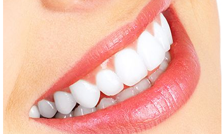 四環(huán)素牙如何美白多少錢？