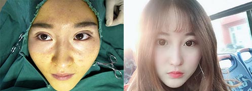 雙眼皮修復(fù)效果對比圖1