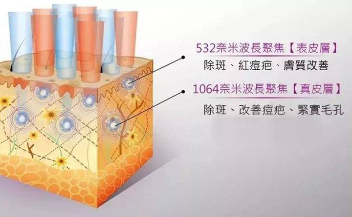 皮秒祛斑恢復(fù)期多久？