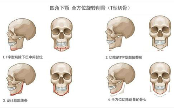 太原麗都整形專(zhuān)家：切下頜角手術(shù)風(fēng)險(xiǎn)主要是這六點(diǎn)