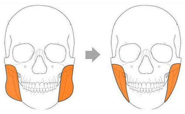 咬肌太大怎么辦？