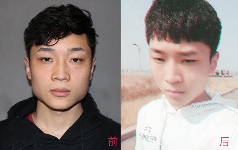 瘦臉針、面部吸脂如何選擇？