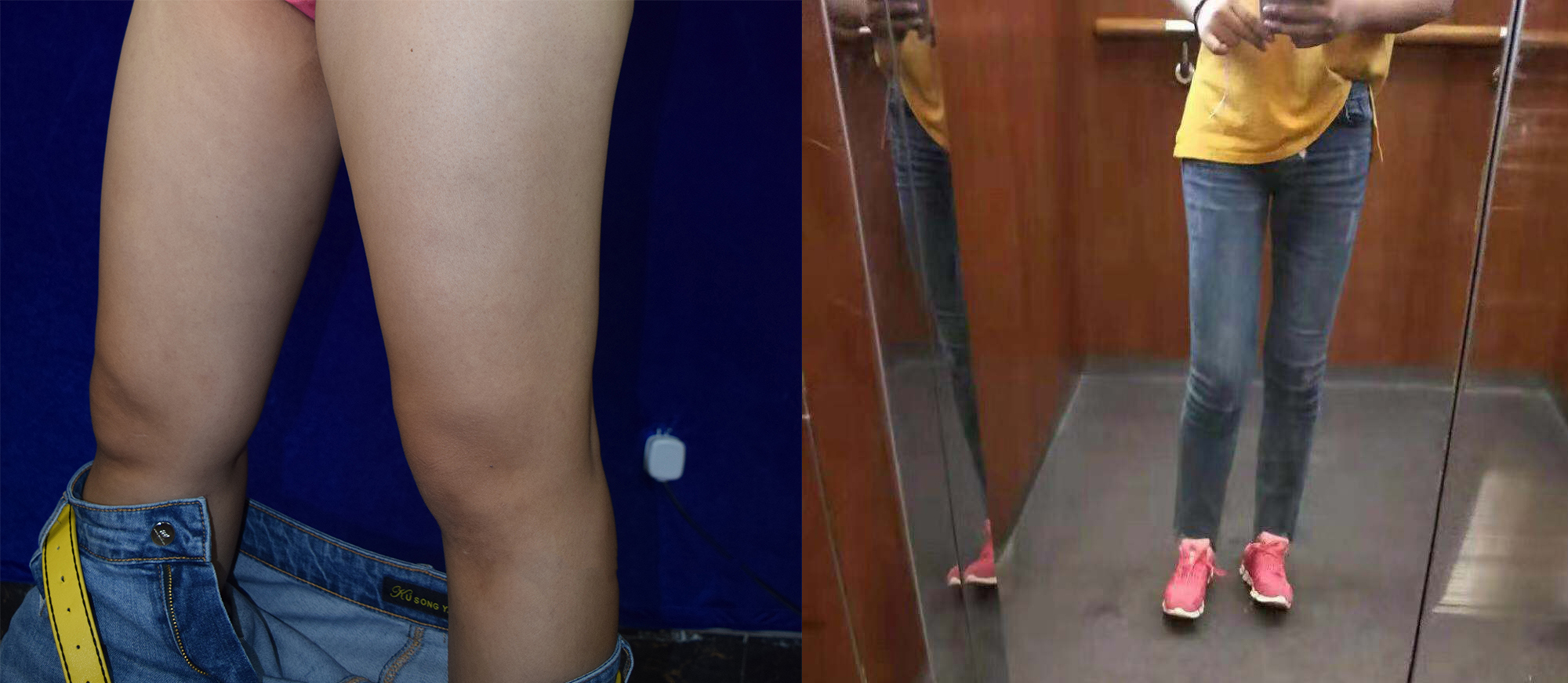 大腿吸脂手術(shù)效果圖1