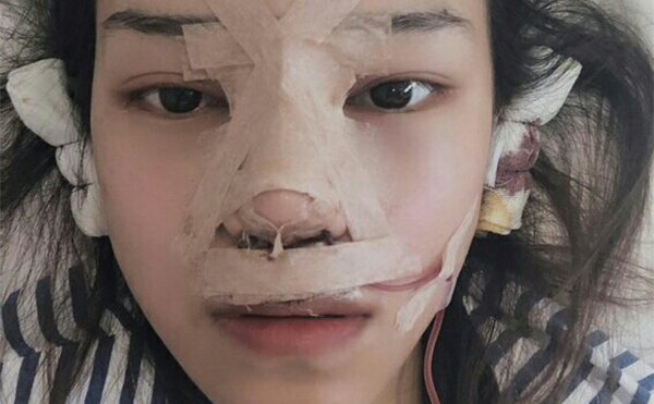 隆鼻術(shù)后當(dāng)天