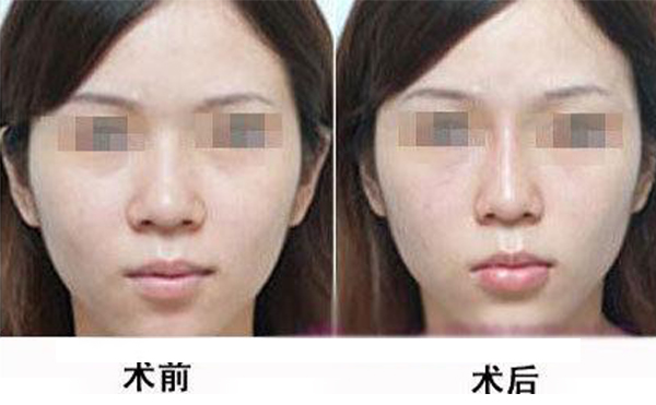 鼻頭縮小手術是怎么做的？術后應該怎么護理