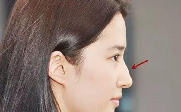 駝峰鼻要怎么改善？