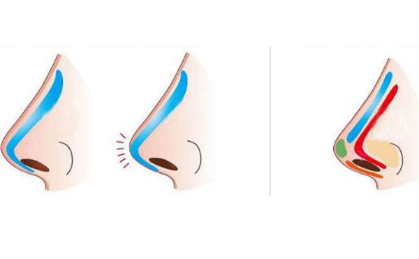 假體隆鼻術(shù)后假體下滑是什么原因?出現(xiàn)下滑該怎么處理?