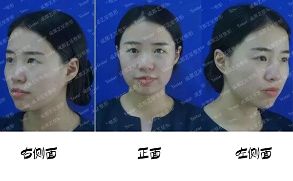 福州名韓整形改善蒜頭鼻大概要花多少錢？