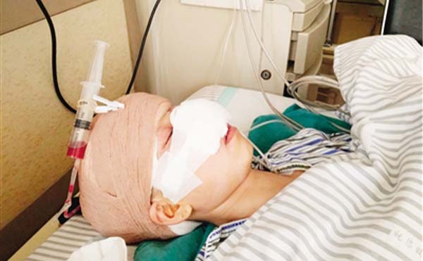 取鼻假體要重點注意什么