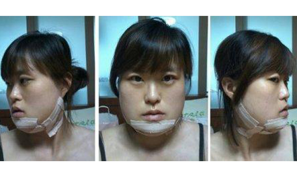 下頜角整形手術(shù)恢復(fù)期是多久?怎樣能縮短恢復(fù)時間?