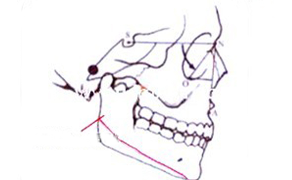 沈陽(yáng)伊美爾整形：下頜角肥大矯正就是這么簡(jiǎn)單