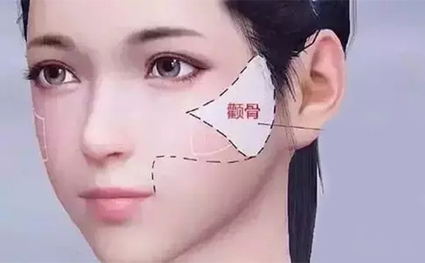 顴骨整形術(shù)后基本的護理措施有哪些?